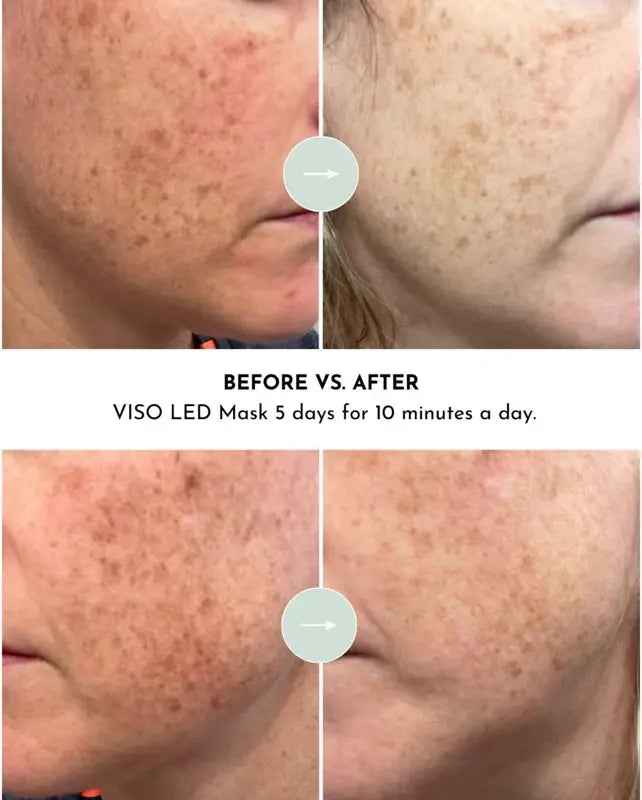 VISO - FDA Certified Red Light Therapy Mask